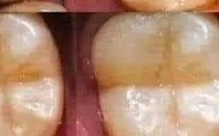 Natural Remedies for Cavities: Tips to Keep Your Teeth Healthy