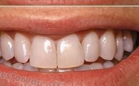 Quick Teeth Whitening with Banana Peels: Transform Yellow Teeth to Shiny White in Just 2 Minutes