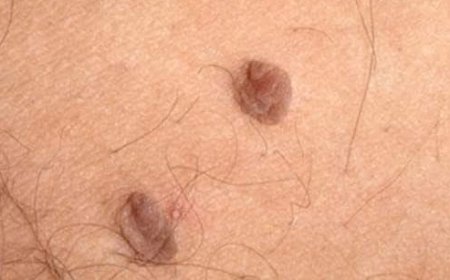 How to Remove Skin Tags and Warts Overnight: Safe and Effective Methods