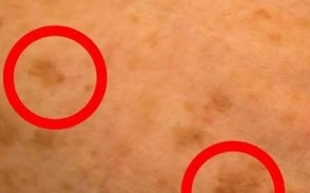 The BEST Vitamin to Remove Age Spots