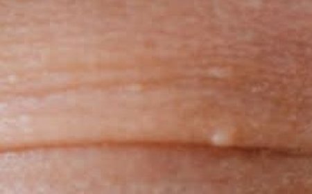 How to Get Rid of Milia Naturally and Effectively