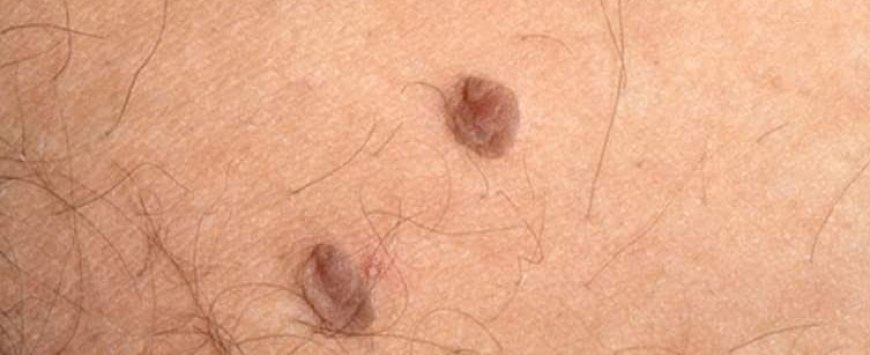 How to Remove Skin Tags and Warts Overnight: Safe and Effective Methods