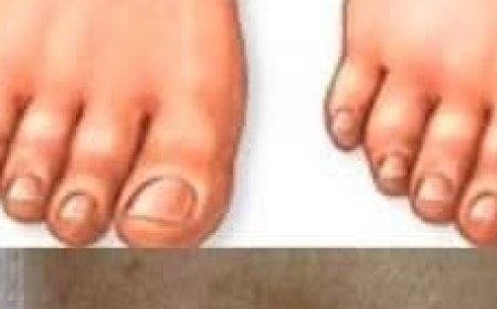 Natural Remedy for Reducing Leg and Foot Swelling