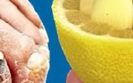 Nail Fungus Removal: 100% Natural