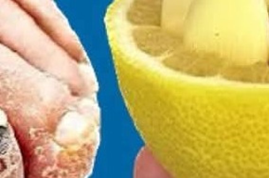 Nail Fungus Removal: 100% Natural