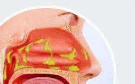 8 Ways To Get Rid Of Phlegm And Mucus In Chest And Throat