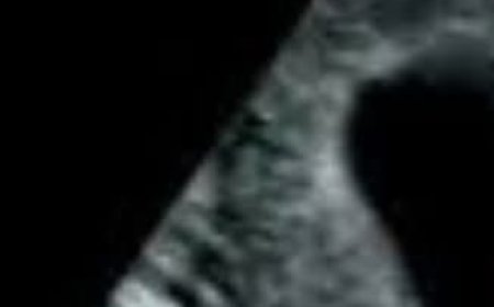 One Step Closer: Scientists Identify a Potential Prenatal Cause of Autism