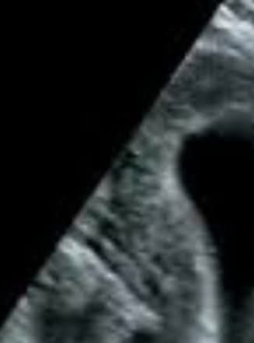 One Step Closer: Scientists Identify a Potential Prenatal Cause of Autism