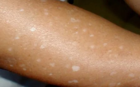 What’s Behind Those White Spots on Your Skin? Possible Causes You Should Know