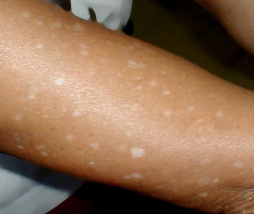 What’s Behind Those White Spots on Your Skin? Possible Causes You Should Know